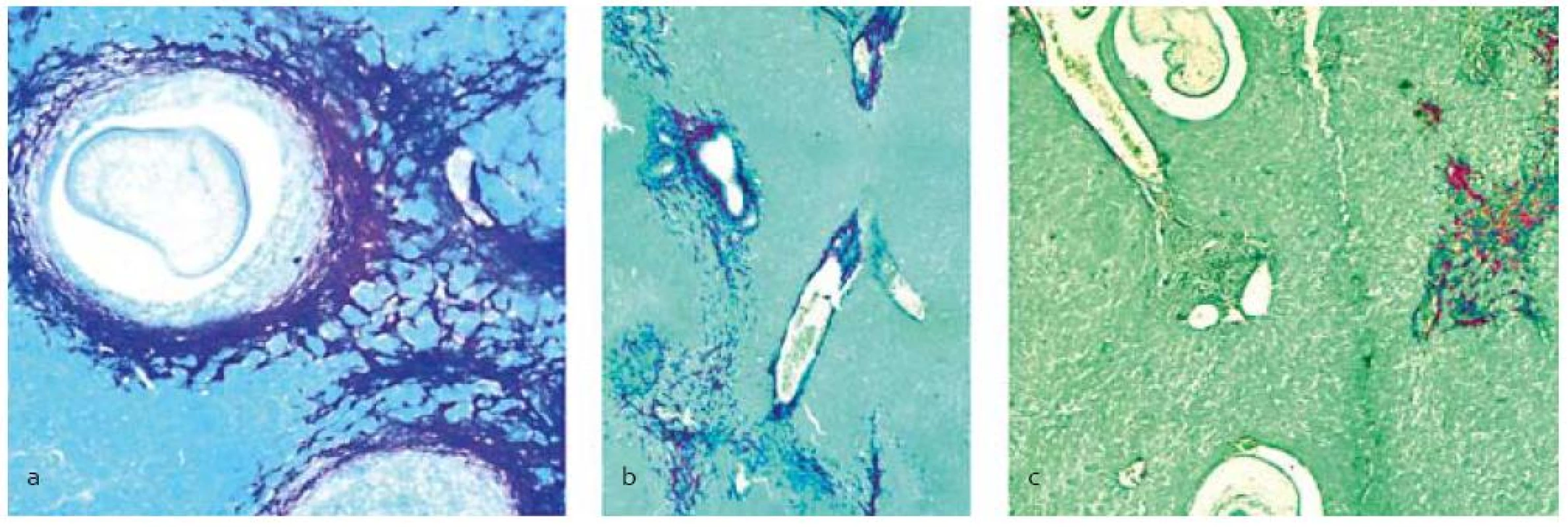 Histopatologická analýza pečene s infekciou larvami M. vogae po terapii praziquantelom samotným (b) a v kombinácii so silymarínom (c), (a) – neliečená kontrola. Akumulácia kolagénu počas fibrogenézy sa lokalizovala pomocou farbenia picrosirius red okolo lariev, ciev, poškodeného tkaniva a difúzne uloženého v parenchýme.&lt;br&gt;
Fig. 1. Histopathological analysis of the liver infected with M. vogae larvae after treatment with praziquantel alone (b) and combined with silymarin (c), (a) – untreated control. Accumulation of the collagen during fibrogenesis was localized by the picrosirius red staining around larvae, vessels, destroyed tissue and as diffused lesions in the parenchyma.