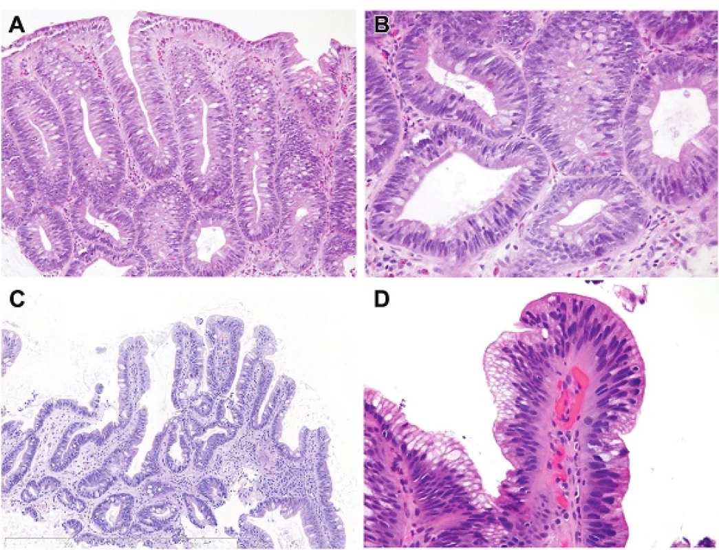 A. Intestinal type dysplasia. In rare examples, intestinal type low-grade dysplasia resembles a colonic tubular adenoma, as in this case, sometimes even interpreted as adenomatous changes. The nuclei are “pencillate”/elongated, hyperchromatic and are all oriented perpendicular to the basement membrane. H&amp;E (200x). B. This is a detail of image A. Note that the nuclei are stratified and that goblet cells are easy to identify. There are Paneth cells in the upper left part of the field. H&amp;E (400x). C. This example of low-grade dysplasia with intestinal differentiation shows a typical density of glands and the pits form tubules the same size as those in nondysplastic columnar mucosa. Note that, although goblet cells are readily identified, there are gastric foveolar cells admixed such that it can be viewed as a mixed type of dysplasia (“incomplete intestinal”). H&amp;E (100x). D. Intestinal type low-grade dysplasia. This is the surface. Note in this case, there are some surface foveolar cells such that the dysplasia is mixed in the manner of incomplete intestinal metaplasia. Note that the nuclei are hyperchromatic at the surface but retain their polarity but show an abrupt transition to the adjacent non-neoplastic epithelium. H&amp;E (400x).