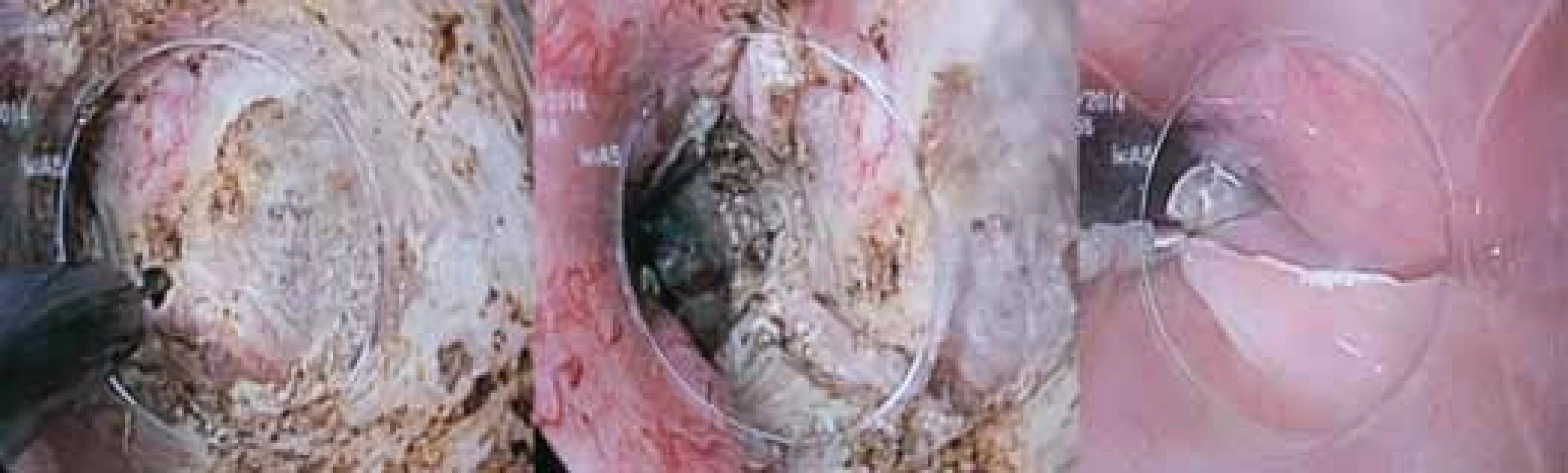 A – Myotómia distálnych cirkulárnych vlákien tela pažeráka; B – dokončená myotómia dolného pažerákového zvierača; C – uzavretie slizničného defektu endoklipmi.