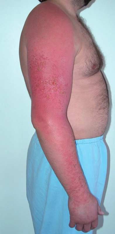 Fotoalergická kontaktní dermatitida na pravé paži a na rameni (ketoprofen).