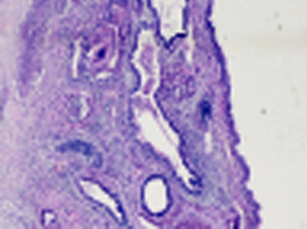 Smíšený germinální tumor tvořený strukturami nezralého teratomu se strukturami žlázového epitelu a primitivního mezenchymu (barvení hematoxylin-eosin, původní zvětšení 40x)
Fig. 5. The mixed germ-cell tumor formed with the ungrown teratoma with the structures of adenous epithelium and primitive mesenchyma (coloured in hematoxylin-eosin, 40x zoomed)