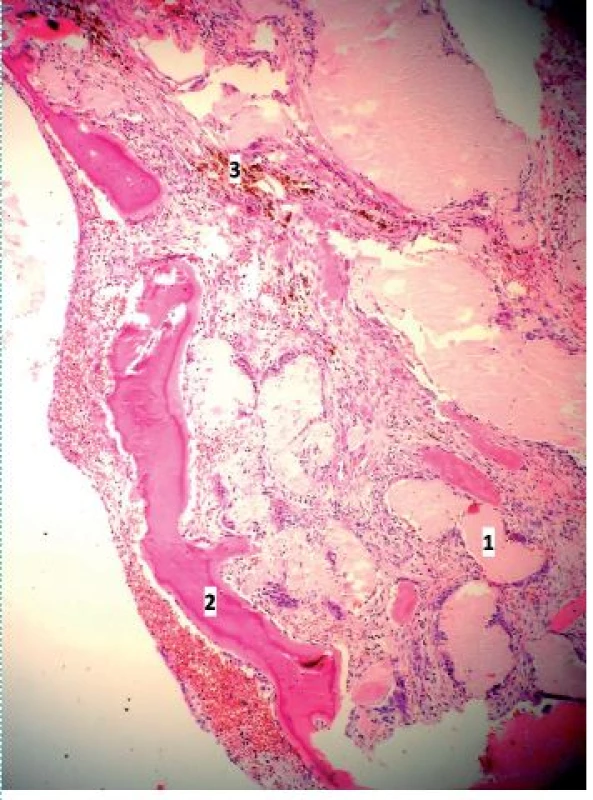 Stěna ureteru a pánvičky s depozity amyloidu a lamelami metaplastické osifikace: 1 – amyloid, 2 – lamelky metaplastické osifikace, 3 – hemosiderin (barvení Fraser, zvětšení 100×)
Fig. 2. The wall of the ureter and pelvis kidney with amyloid deposits and metaplastic calcification: 1 – amyloid, 2 – plates of metaplastic calcification, 3 – hemosiderin (Fraser staining, magnification 100×)