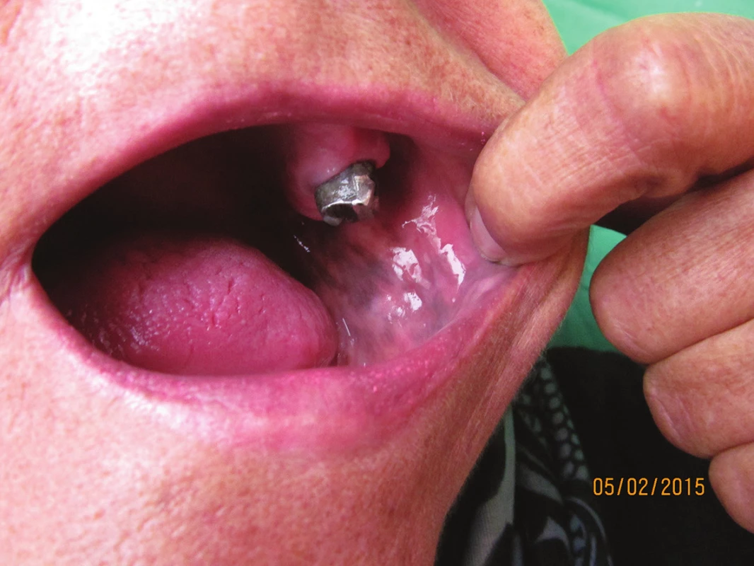 Postižení sliznice dutiny ústní