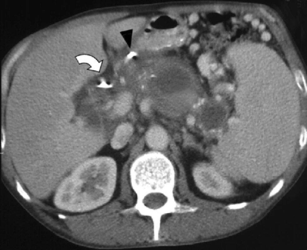 Kontrolní postkontrastní CT po embolizaci ukazuje absenci opacifikace pseudo-aneuryzmatu. Kovové spirály v levé gastrické tepně (šipka). Plastikový drén v hepatocholedochu (ohnutá šipka).