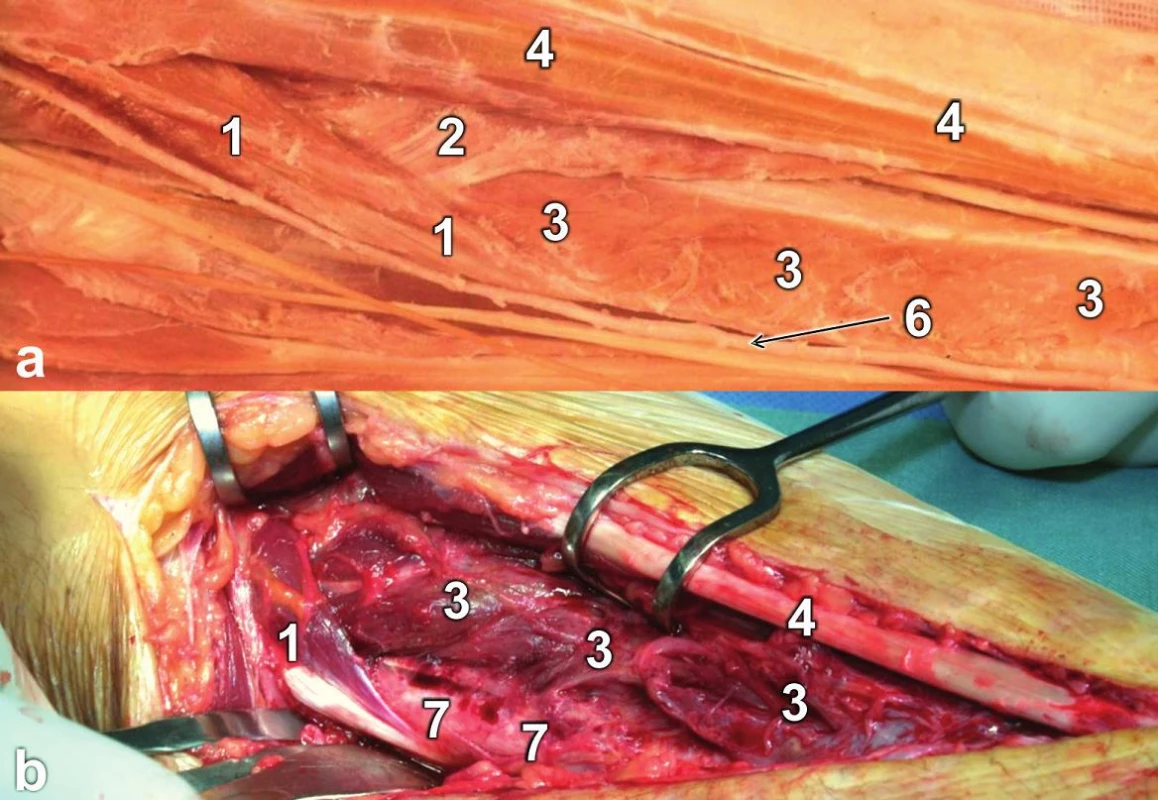 Oblast úponu m. pronator teres: a – anatomický preparát (pravá strana); b – peroperační situace: 1 – m. pronator teres, 2 – m. flexor digitorum superficialis (caput radiale), 3 – m. flexor pollicis longus, 4 – m. flexor carpi radialis, 6 – a. radialis, 7 – diafýza radia.
Fig. 6: Site of insertion of the pronator teres: a – anatomical specimen (right side); b – intraoperative view: 1 – pronator teres, 2 – flexor digitorum superficialis (radial head), 3 – flexor pollicis longus, 4 – flexor carpi radialis, 6 – radial artery 7 – radial shaft.