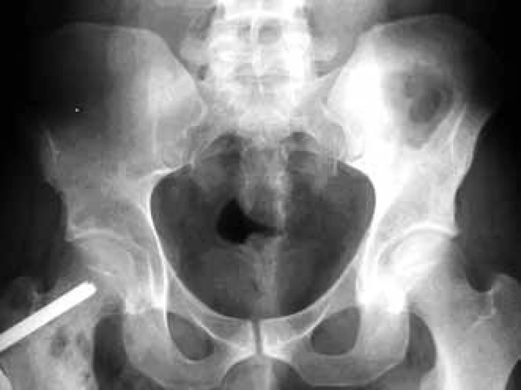 Femoral osteolytic deposit on the right of the osteosynthetic material in an x-ray image of the pelvis.