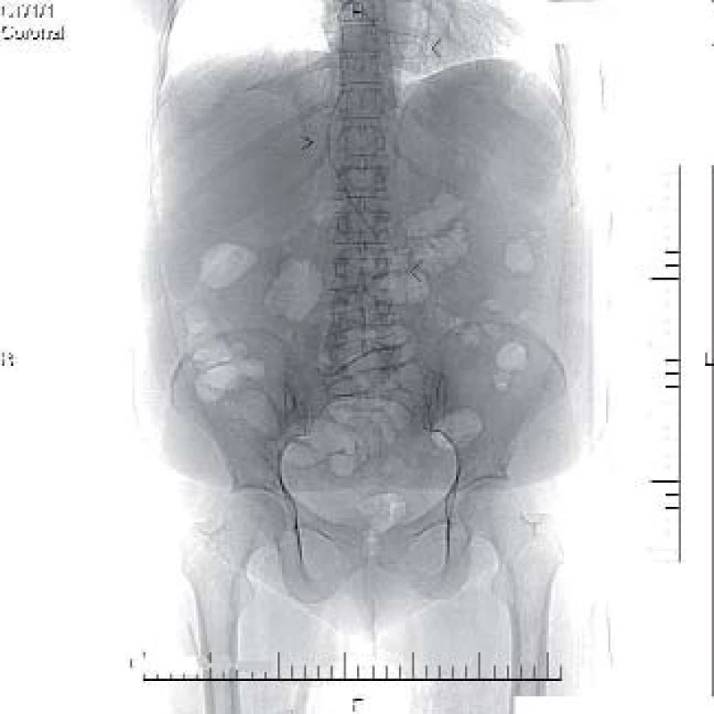 Nativní CT scan se zobrazeným dislokovaným double J stentem (viz šipky).