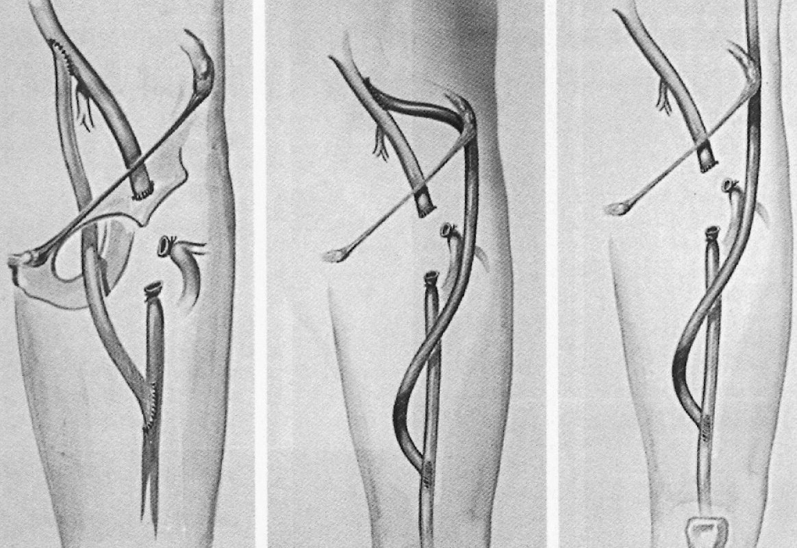 Možnosti extraanatomickej rekonštrukcie v oblasti stehna
Pic. 5. Options for extraanatomical reconstructions in the thigh region