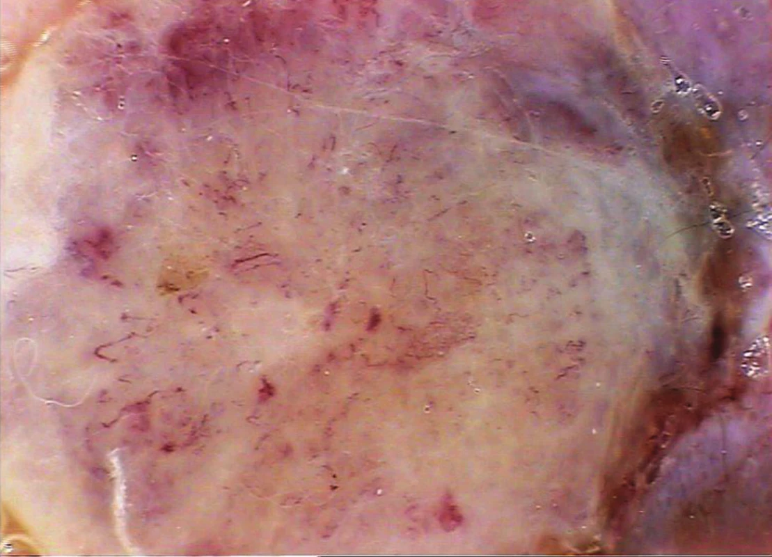 Středně silný melanom (Breslow 1,8 mm)
Dermatoskopicky je nápadný cévní polymorfismus na bělavém pozadí léze.