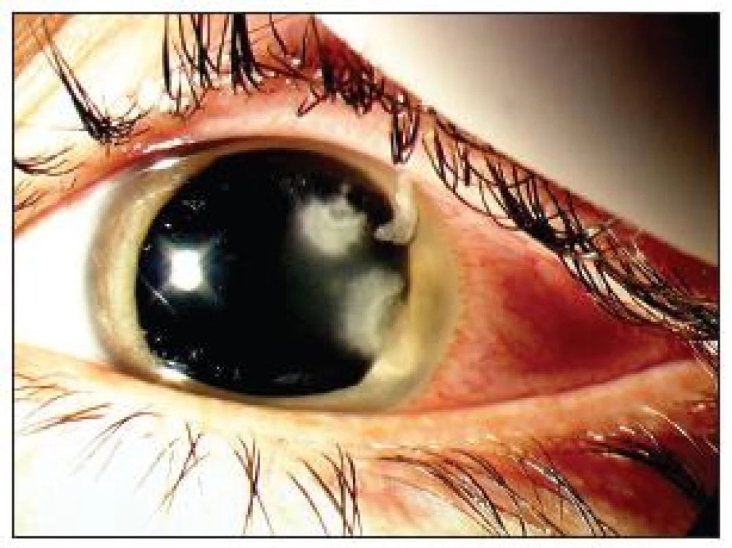 Dvě akutní ulcerózní ložiska na rohovce oka levého
