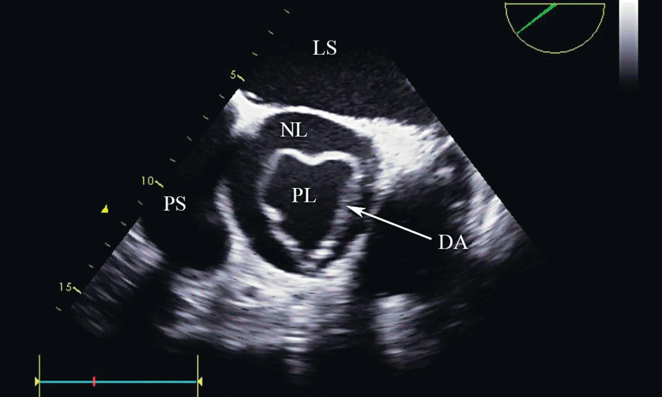 Disekce typu A v ascendentní aortě, krátká osa, TEE