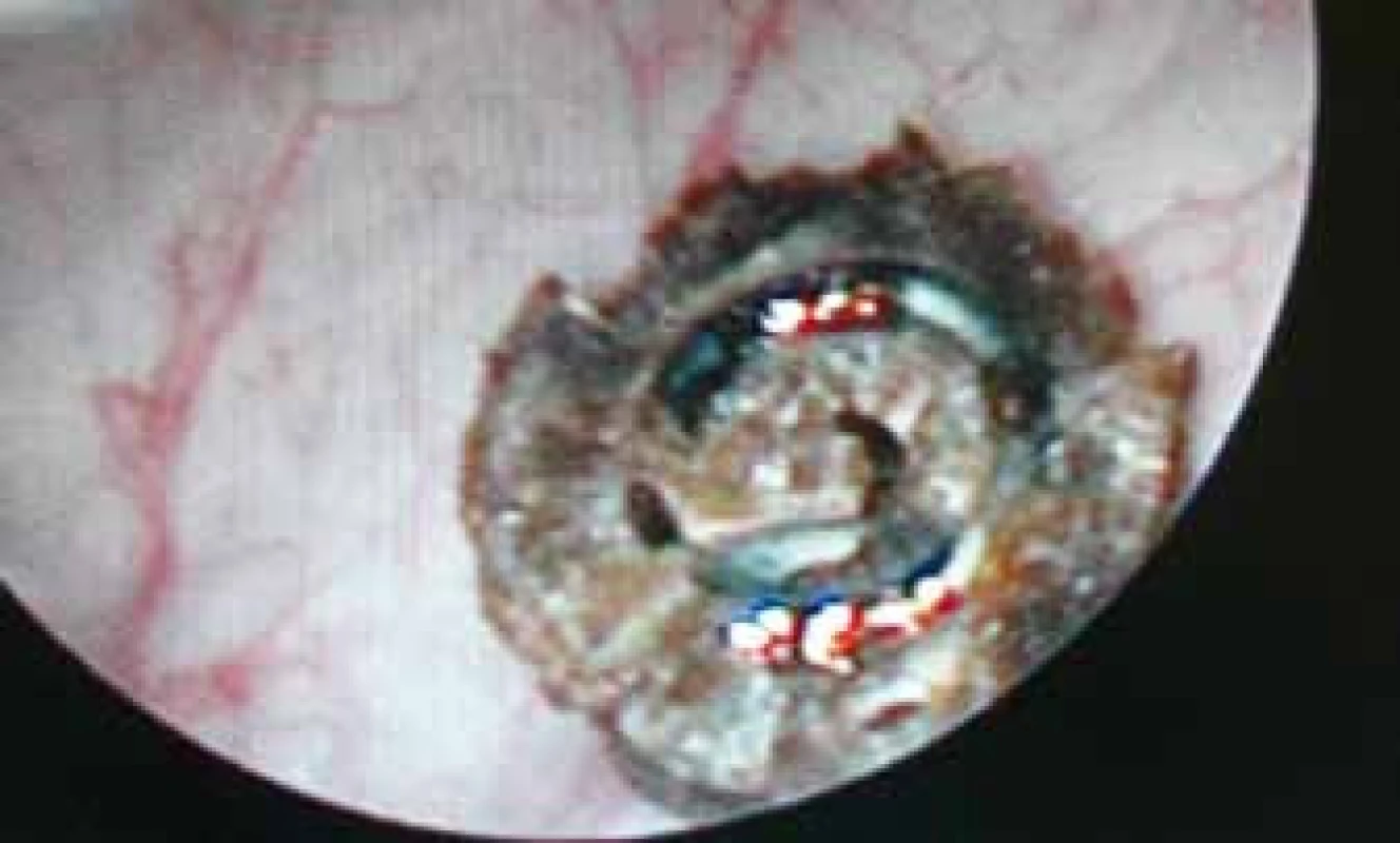 Peroperační obraz spirály v močovém měchýři
Fig. 3. Intraoperative image of tacker in the urinary bladder