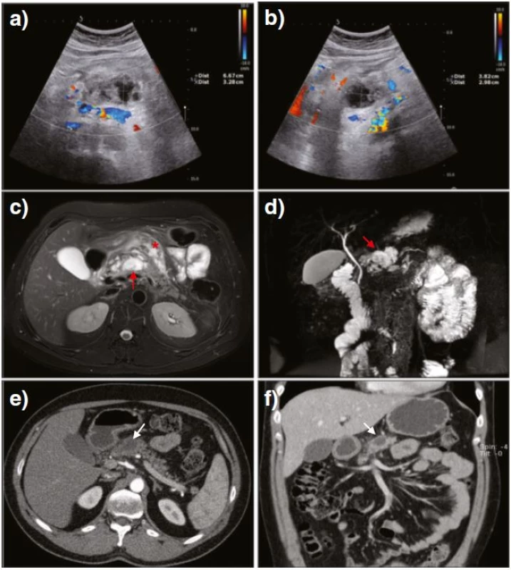 US after the diagnostic angiography revealed a progressive decrease of the serpinginous formations as well as a cystic lesion gradually increasing in size (a, b). Fat-suppressed &lt;i&gt;T&lt;sub&gt;2&lt;/sub&gt;&lt;/i&gt;-weighted MR images depicted fluid characteristics in the neck of the pancreas (c, &lt;i&gt;red arrow&lt;/i&gt;) and in the peripancreatic fat (c, &lt;i&gt;red asterisk&lt;/i&gt;) indicating an area of intra-parenchymal necrosis along with some peripancreatic edema. MR cholangiopancreatography confirmed minor peripancreatic fluid collection in the neck of the pancreas (d, &lt;i&gt;red arrow&lt;/i&gt;). Long-term CT follow-up showed no evidence of previous vascular malformation along with the remaining peripancreatic fluid collection (e, f, &lt;i&gt;white arrows&lt;/i&gt;)