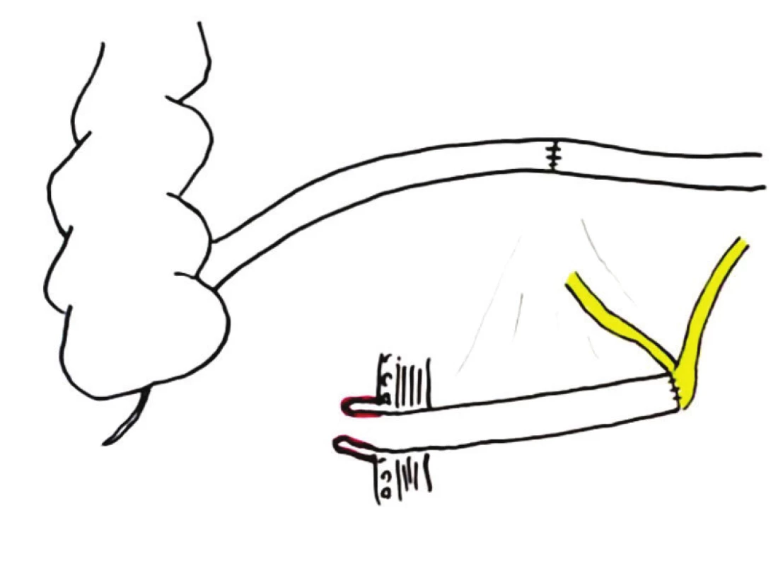 Ureteroileální konduit (kutánní ureteroileostomie) – schéma
Fig. 2: Ileal conduit diagram