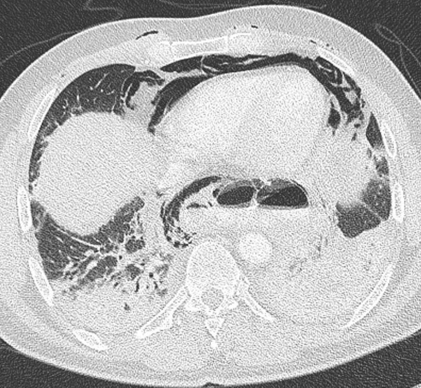 Axiální obrazy CT pneumomediastinum v plicním okénku
Fig. 7. Axial CT views of the pneumomediastinum in the lung window