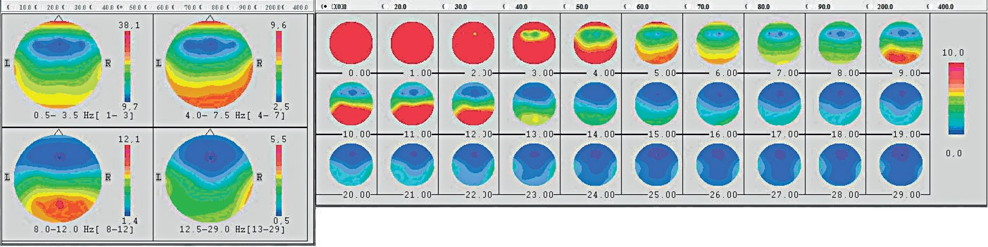Frekvenční mozkové mapování EEG aktivity při hře na housle (proband 5) - červená barvy je maximum, modrá je minimum aktivity.