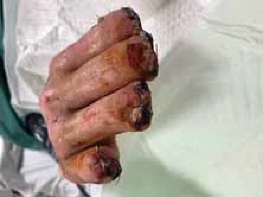 Appearance of right hand after operation (frontal view).