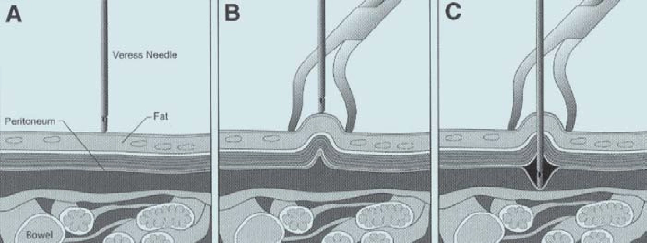 (A) Veressova jehla před proniknutím stěnou břišní. Střevní kličky jsou v blízkosti břišní stěny. (B) Elevací břišní stěny dojde k oddálení peritonea od střevních kliček a zabránění poranění střeva jehlou. (C) Při elevaci břišní stěny může dojít k uvolnění peritonea. Punkce se stává velmi obtížnou. Dochází k insuflaci plynu do prostoru mezi peritoneum a břišní stěnu. Rozpínání arteficiálního prostoru tlačí peritoneum na střevní kličky a punkce se stává nebezpečnou.