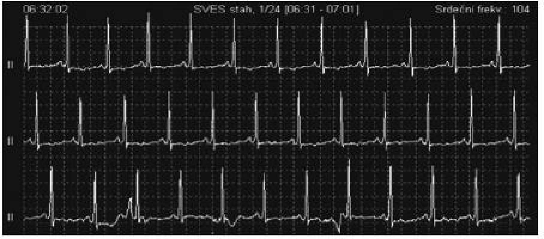 Záznam z EKG holteru při polohování pacienta