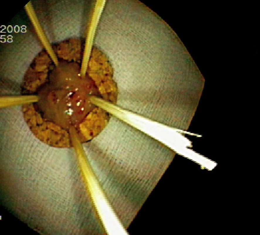 Fixace resekátu na korkové podložce (histologicky „serrated adenoma“)
Pic. 5. Resected specimen fixed on a corc board