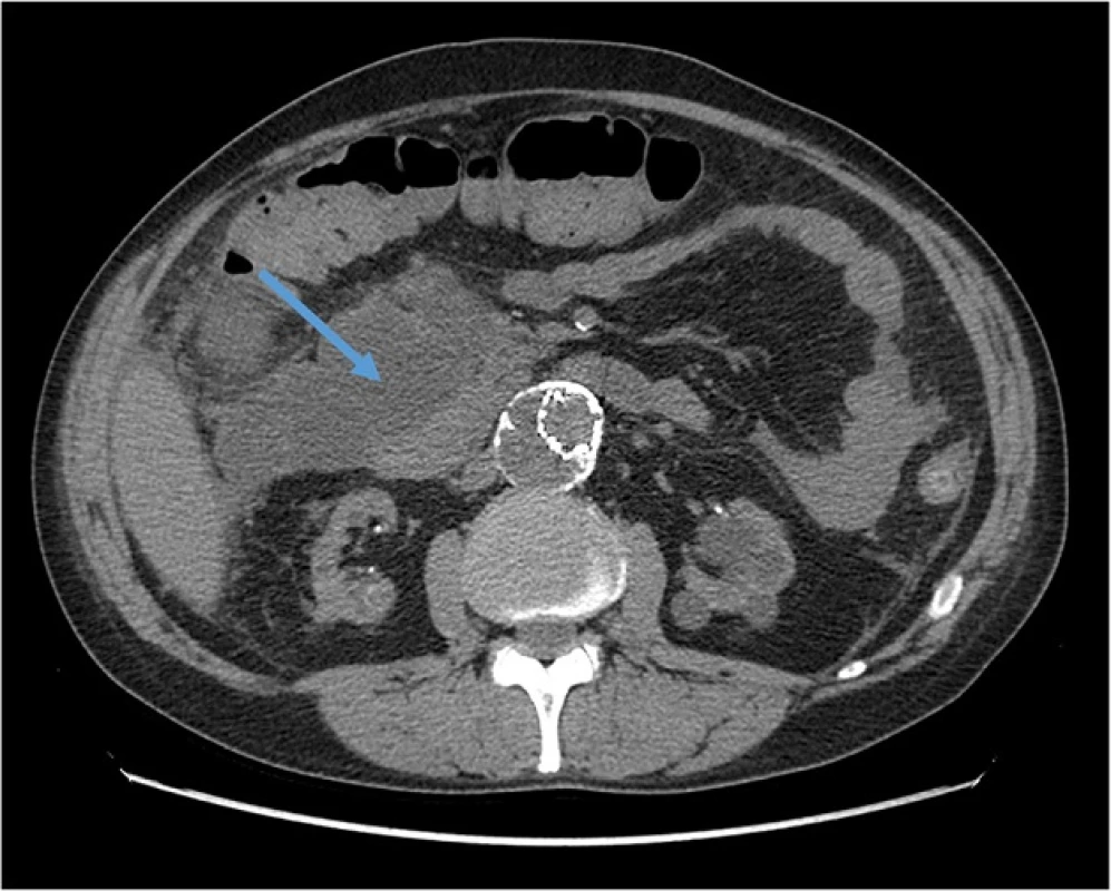 Abdominal CT Scan showing the initial area of patchy necrosis around the head of pancreas