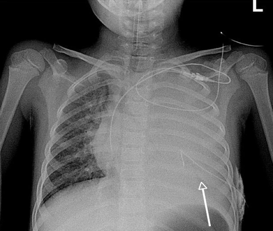 Přehledný RTG skiagram hrudníku pacientky č. 4 ze dne 27. 11. 2009 v A-P projekci na lůžku po přijetí, inzerci centrálního žilního katétru a interkostálního hrudního drénu. – Kompletní zastření levého plicního křídla s kompresí plicního parenchymu (šipka) a tekutinou v pleurálním prostoru. Pravé plicní křídlo s difuzně zmnoženou bronchovaskulární a intersticiální plicní kresbou. Centrální žilní katétr z levé podklíčkové žíly končí na počátku pravé srdeční síně, tracheální kanyla s koncem3 cmnad větvenímhlavních bronchů. Hrudní drén v 6.mezižebří vlevo leží nad bránicí.&lt;br&gt;
Fig. 1. General chest X-ray of a female patient No. 4 fromNovember 27, 2009 in A-P projection in bed after admission, insertion of central venous catheter and intercostals thorax drain. – A complex blurred left lung wing with compressed lung parenchyma (arrow) and a fluid in the pleural space. The right lung wing displaying diffusely multiplied bronchovascular and interstitial lung lineation. The central venous catheter from the left subclavicular vein ends in the beginning of the right cardiac auricle and the tracheal cannula ends 3 cm above the ramification of the main bronchi. The thoracic drain in the 6th intercostals on the left is situated above the diaphragm.