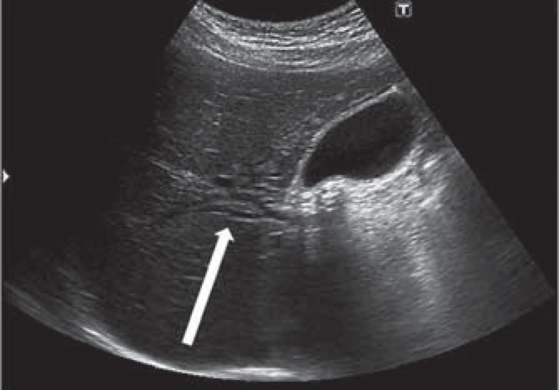 Sonografický obraz dilatace nitrojaterních žlučovod  (šipka).
Fig. 2. Ultrasound image of intrahepatic bile duct dilatation (arrow).