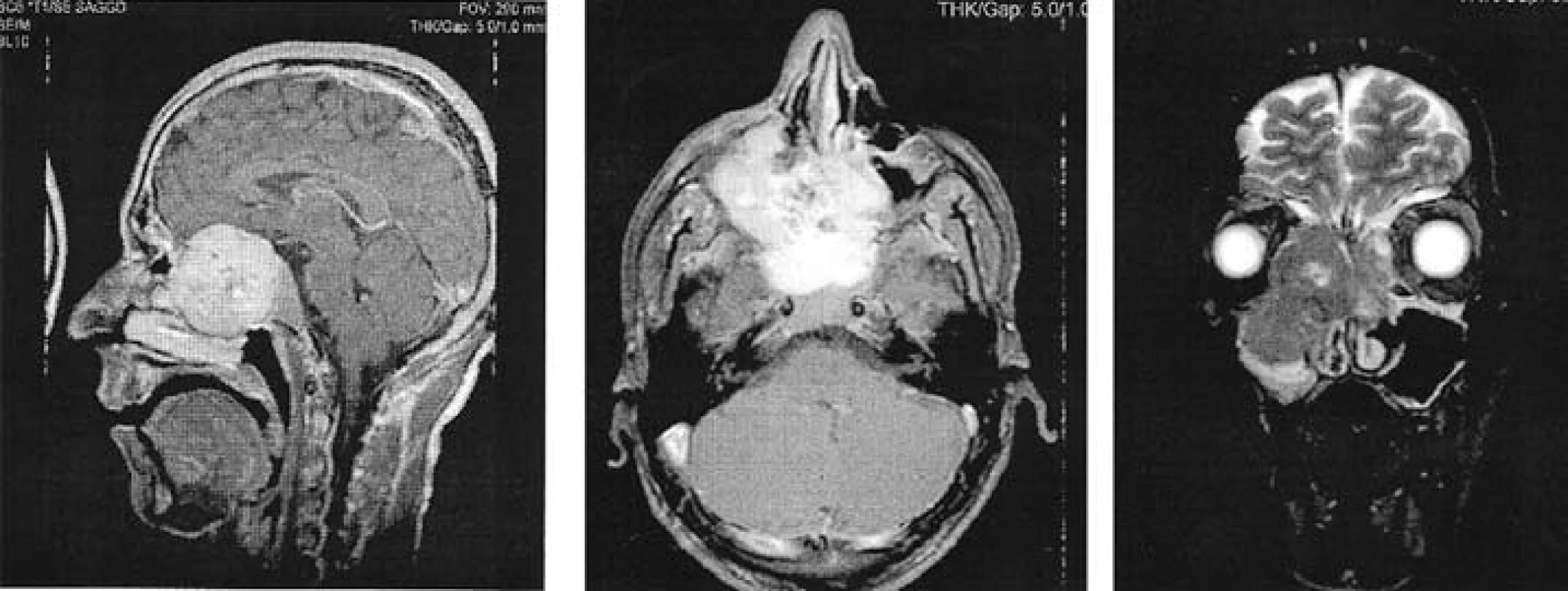 MRI pacienta s několik měsíců „léčenou“ alergickou rýmou (jednalo se o chondrosarkom)