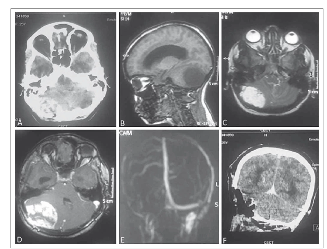 Contrast-enhanced computed tomography (CECT) of the brain showing heterogeneously contrast-enhancing lesion at the right posterior fossa with erosion of the overlying bone (A). On MRI, the lesion is isointense on T1 (B) and hyperintense on T2-weighted image (C) with intensive post-contrast enhancement (D). There is non-visualization of the right transverse sinus (E) on MRA. Figure F is post-operative CECT of the brain showing complete removal of the lesion.