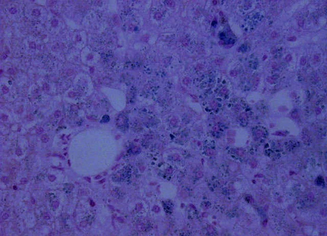 Jaterní biopsie, Fe, 200x – mírná steatóza, hemochromatóza, patrna hojná depozita
Fe pigmentu v hepatocytech i Kuppferových buňkách s intenzitou 4. stupně.