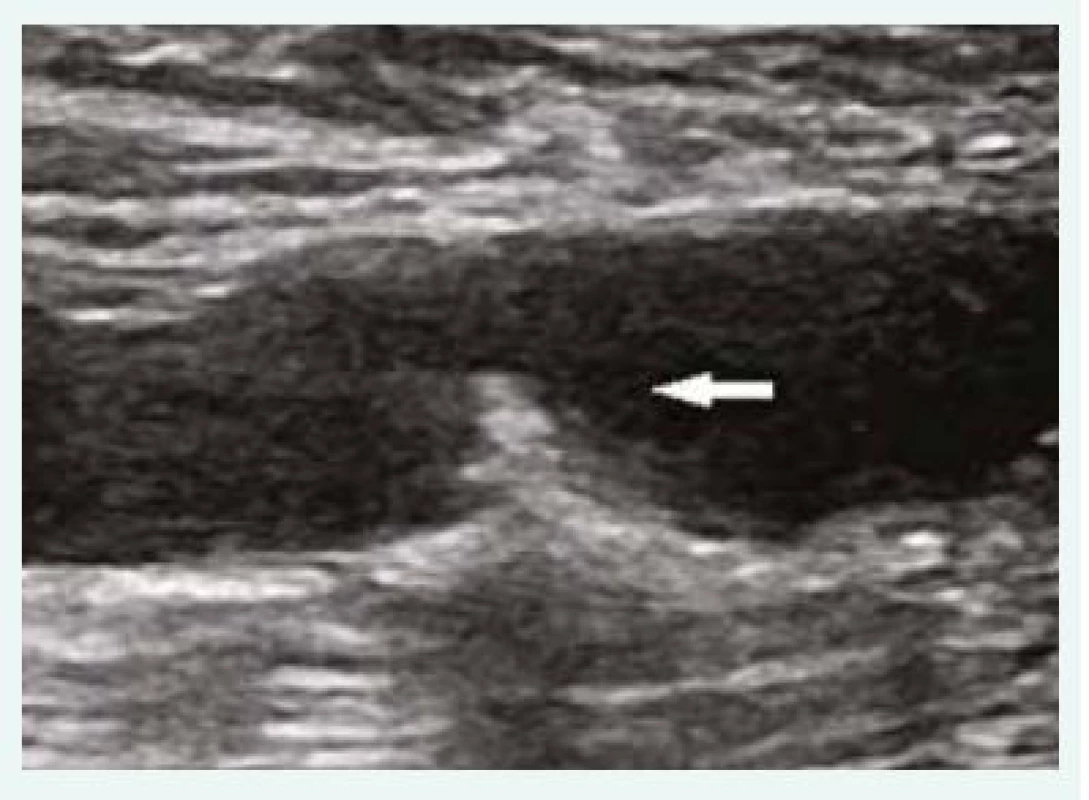 Duplexní ultrasonografie – podélná projekce levé a. femoralis communis; mobilní plát 
s velkým embolizačním potenciálem (šipka).
