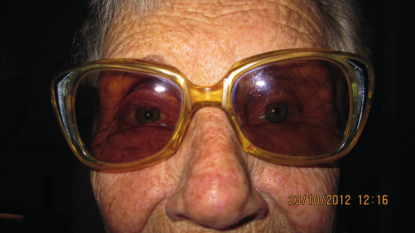 Fotografia pacientky po nasadení epitézy a slnečných okuliarov
