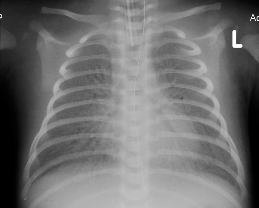 Rtg hrudníku – 12. den života.
Fig. 2. Chest X-ray – 12th day of life.