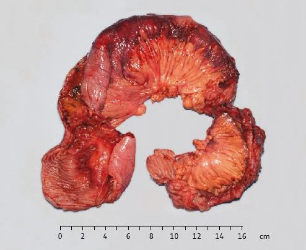 Resekát ilea: sliznice ilea s polypoidně zhrubělými řasami a stenózami.
Fig. 5. Resected ileum: polypoidal changes of ileum mucosa with stenoses.
