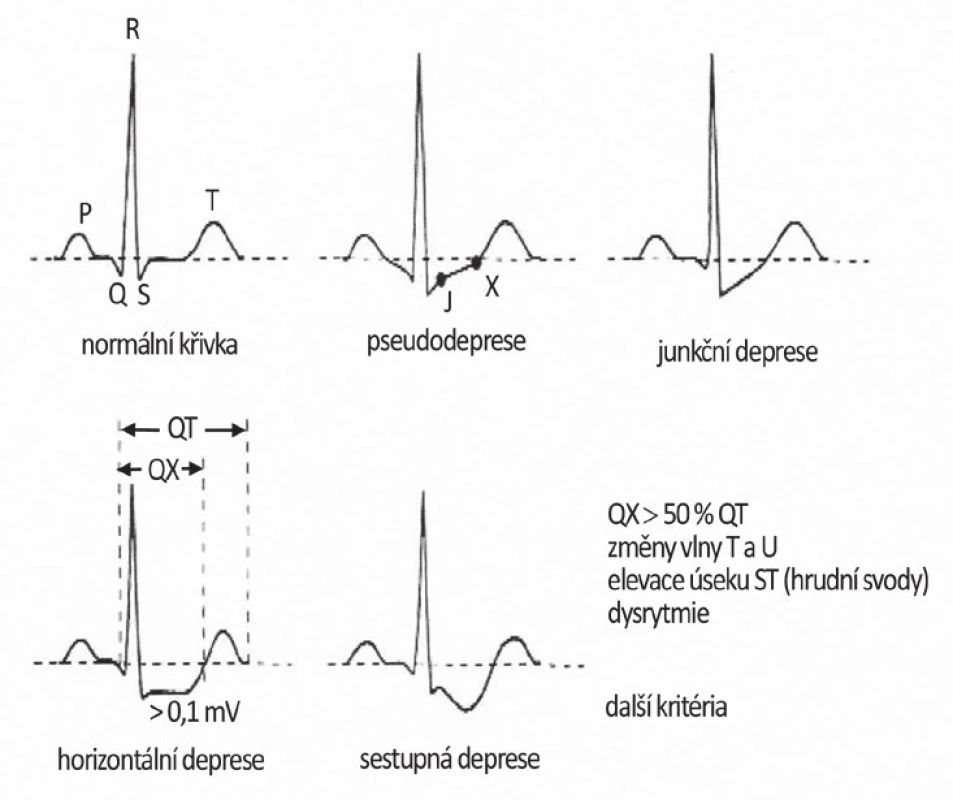 Příklady EKG záznamu - různé druhy deprese ST úseku