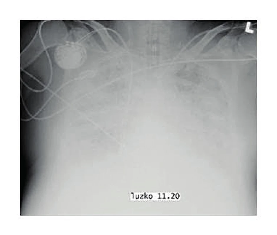 Zadopřední snímek hrudníku pacienta s ARDS