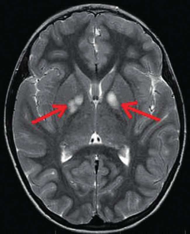 Hypersignální ložiska (FASI/ UBO) v globus pallidum oboustranně (šipky) na MR vyšetření mozku v T2 vážených obrazech u 9leté dívky
