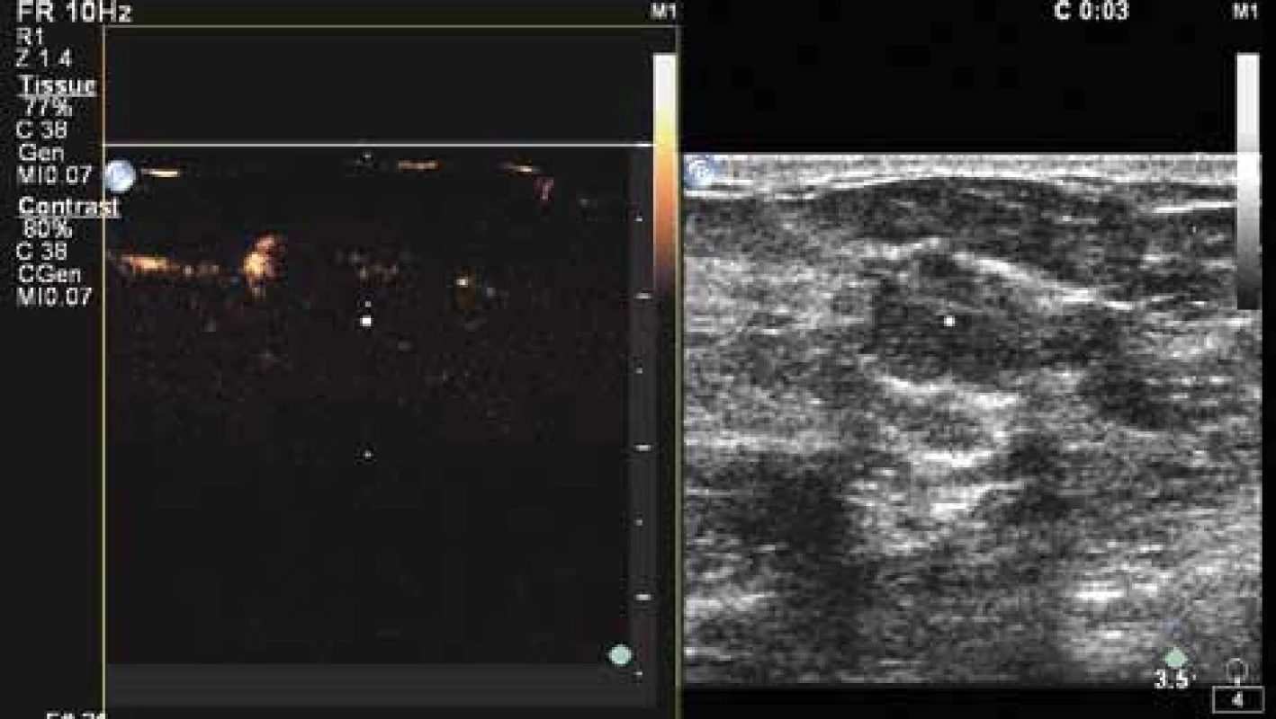 Již ve třetí sekundě po aplikaci kontrastní látky (SONOVUE) je průkazný výrazný cévní kmen - na obrázku vlevo nahoře.
