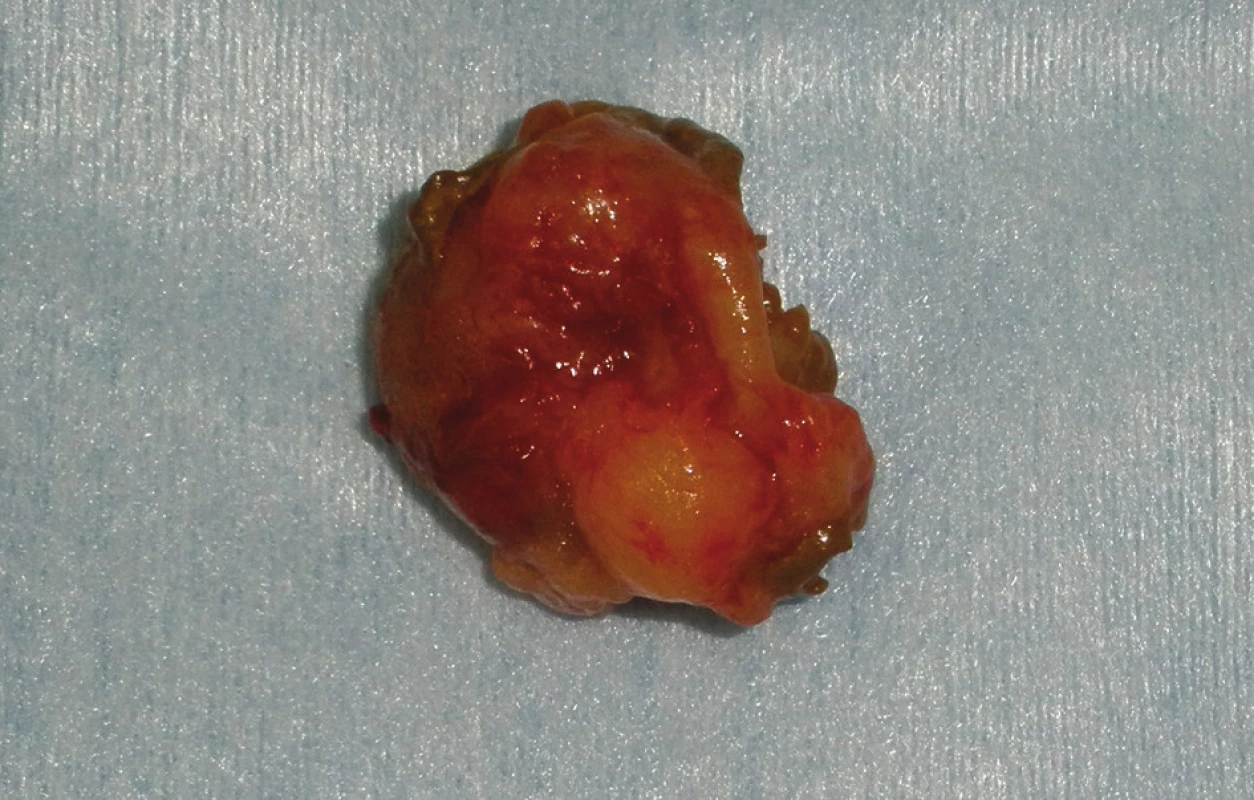 Exstirpovaný tumor
Fig. 4: Removed tumour