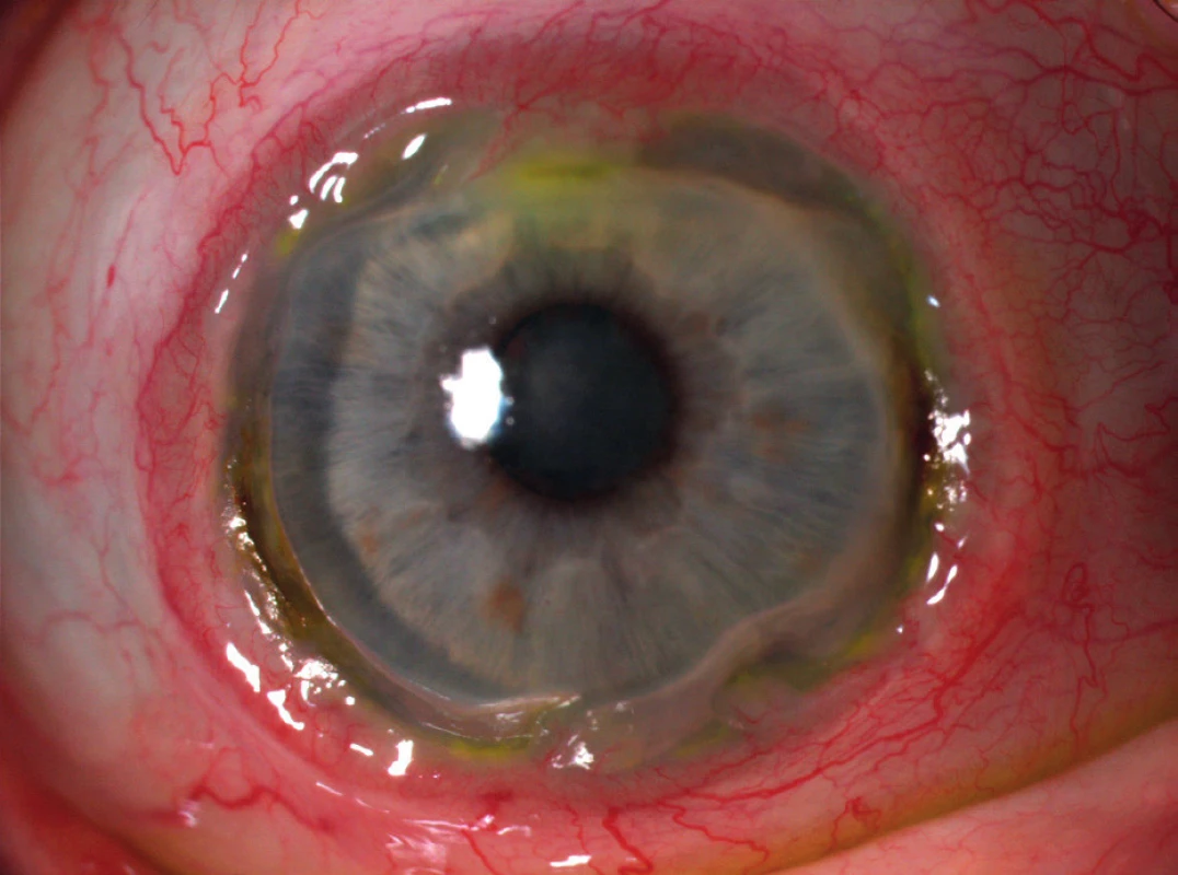 Postižení oka periferní ulcerózní keratitidou po celém obvodu rohovky.