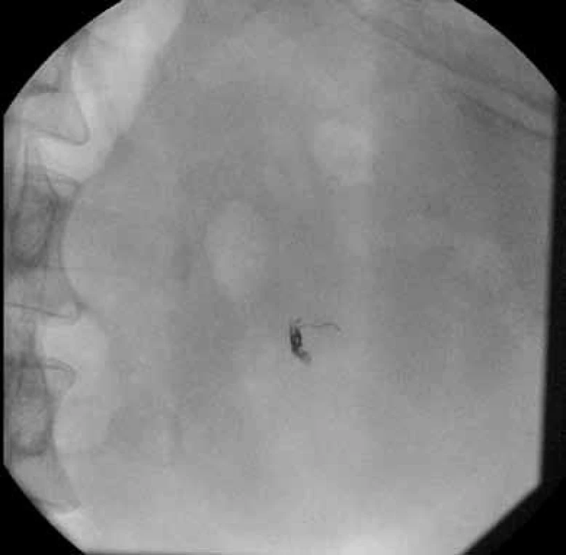 RTG – spirálky uložené do tepny
Fig. 3. X-ray – coils in artery