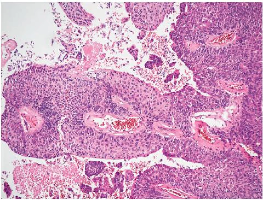 Histologický obraz uroteliálního karcinomu
Fig. 2. Histological picture of urotelial carcinoma