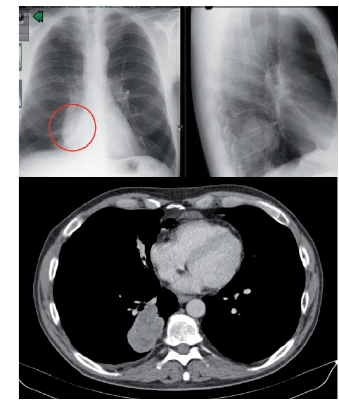 Zadopřední
a boční
skiagram
hrudníku
s nálezem
ložiska průměru
6 cm v dolním
laloku pravé
plíce + CT scan
s nálezem
solidního ložiska
v pravé plíci
vpravo dorzálně
bazálně