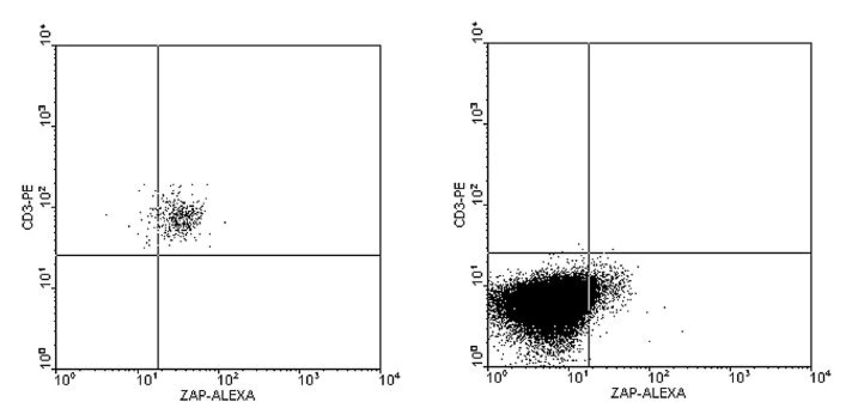 a–b. Imunofenotypizační vyšetření periferní krve u B-CLL s negativitou exprese ZAP-70 na B-lymfocytech. 3-barevné značení (obr. 1).
