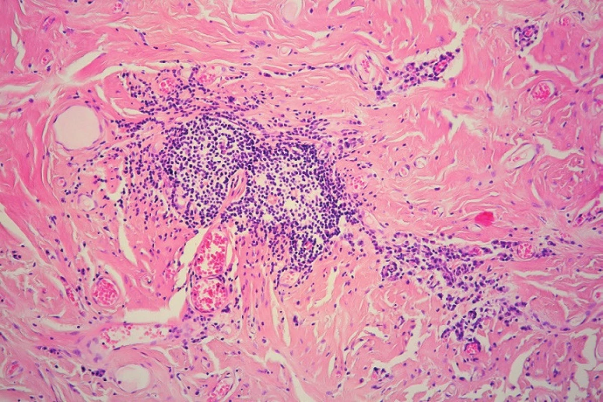 Mononuclear inflammatory cells are mildly dispersed throughout the lesion and focally form lymphoid follicles (HE, 200x).