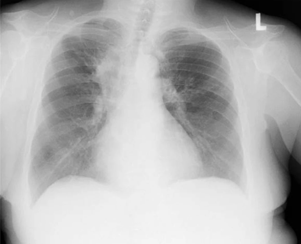 Zadopřední skiagram hrudníku nemocné s bronchiektáziemi při alergické bronchopulmonální aspergilóze