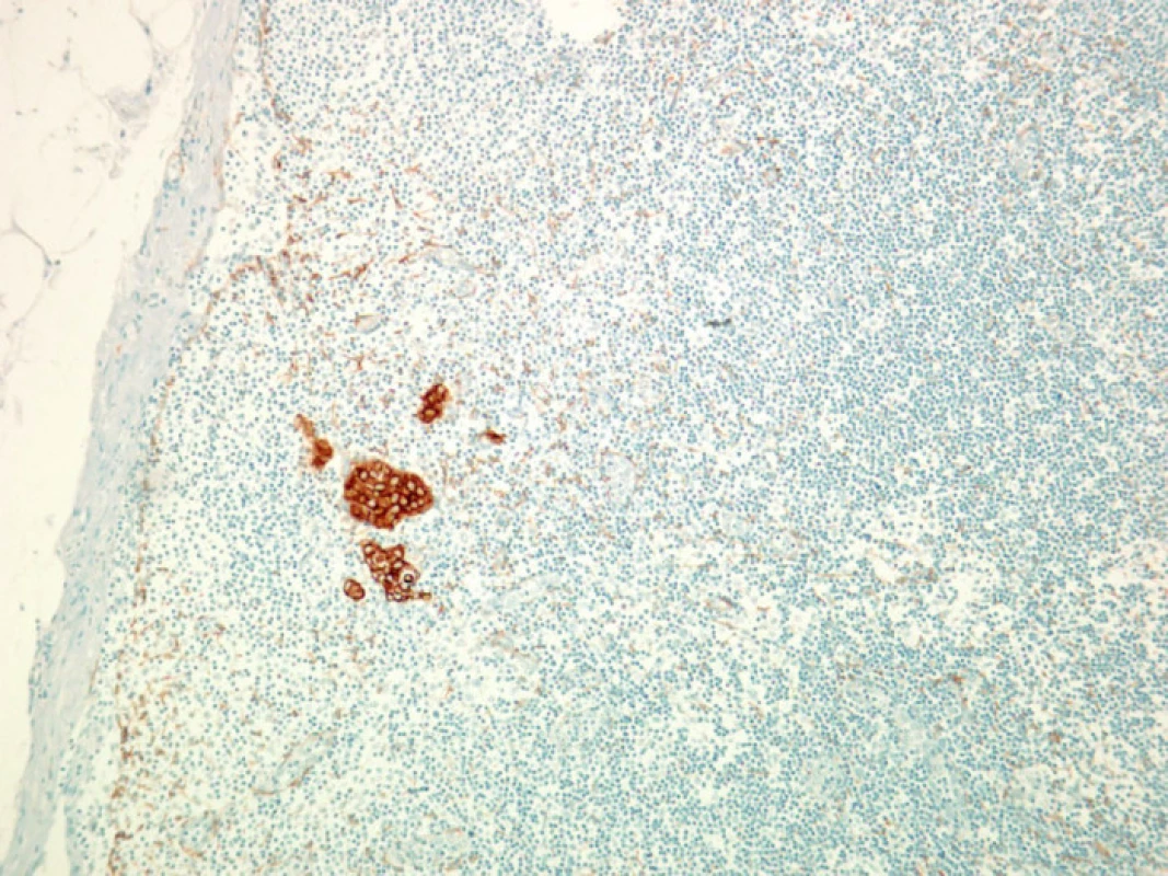 Mikro- a submikrometastázy karcinomu prsu, zobrazeny imunohistochemicky
Fig. 2. Micro- and submicrometastases of the breast carcinoma, on immunohistochemistry
