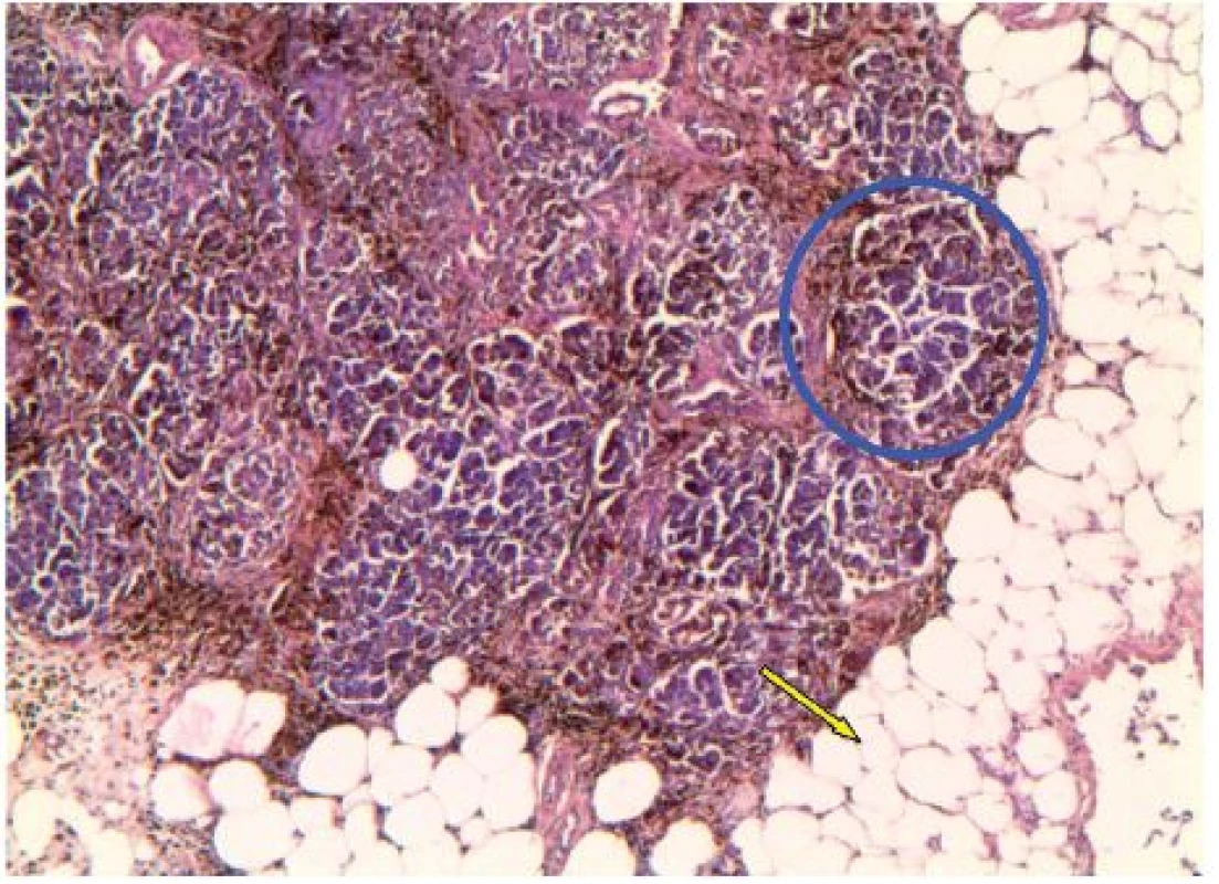 Hemosiderinová depozita v lalůčku pankreatu (modrá elipsa) a steatóza pankreatu (žlutá šipka), hematoxylin-eosin