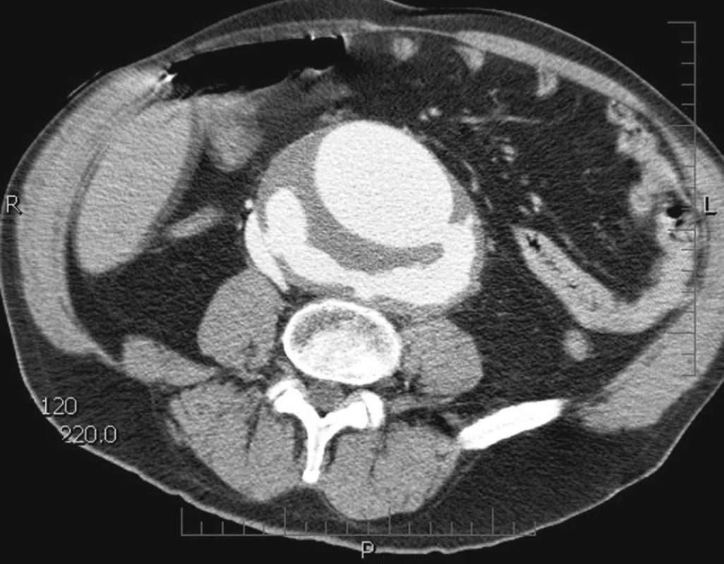 CTA prokázána ruptura velkého aneuryzmatu břišní aorty do dolní duté žíly.
Fig. 1. CTA demonstrated a rupture of a large abdominal aortic aneurysm into the inferior vena cava.