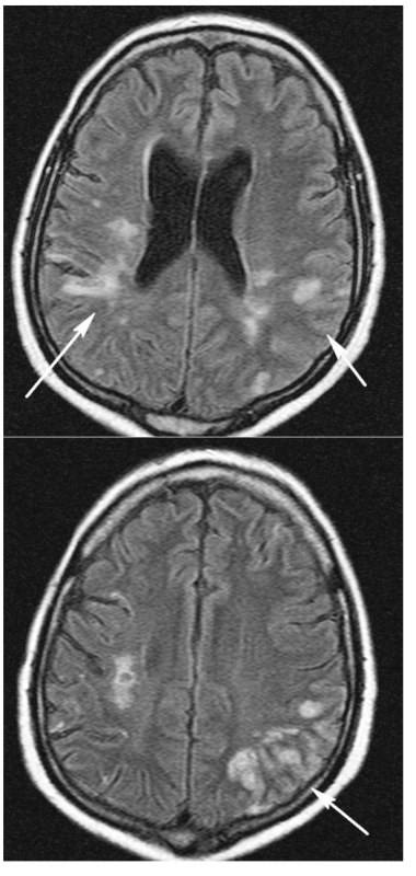 MR vyšetření mozku listopad 2005, sekvence FLAIR v axiální rovině.
Vpravo paraventrikulárně a subkortikálně spíše změny staršího data (3a,b). 
Vlevo parietálně plošné edematosní prosáknutí kortikálně, které odpovídá změnám vaskulopatickým (3b).